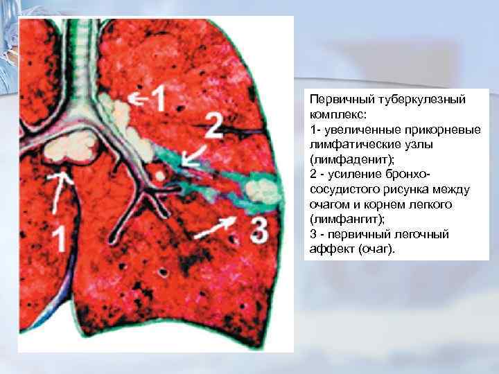 Первичный туберкулезный комплекс: 1 - увеличенные прикорневые лимфатические узлы (лимфаденит); 2 - усиление бронхососудистого