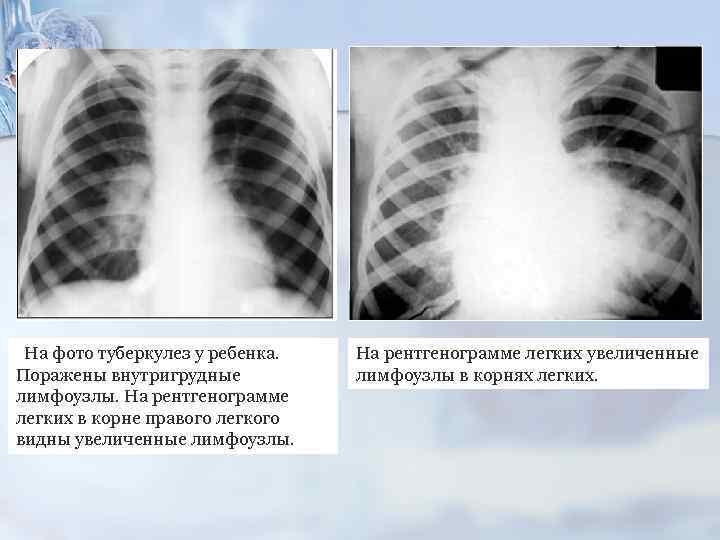 На фото туберкулез у ребенка. Поражены внутригрудные лимфоузлы. На рентгенограмме легких в корне правого