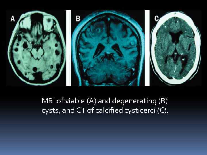MRI of viable (A) and degenerating (B) cysts, and CT of calcified cysticerci (C).