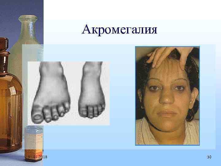 Акромегалия 31. 01. 2018 30 