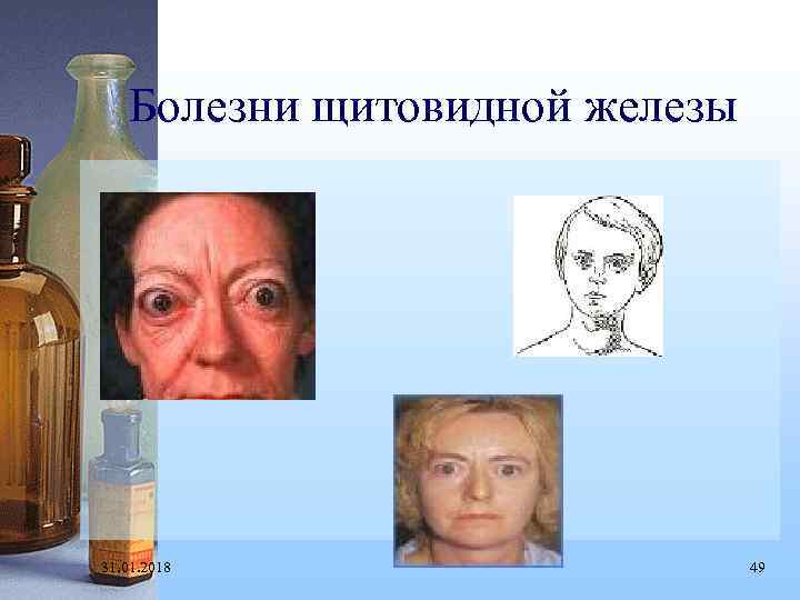 Болезни щитовидной железы 31. 01. 2018 49 