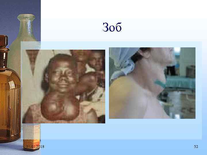 Зоб 31. 01. 2018 52 