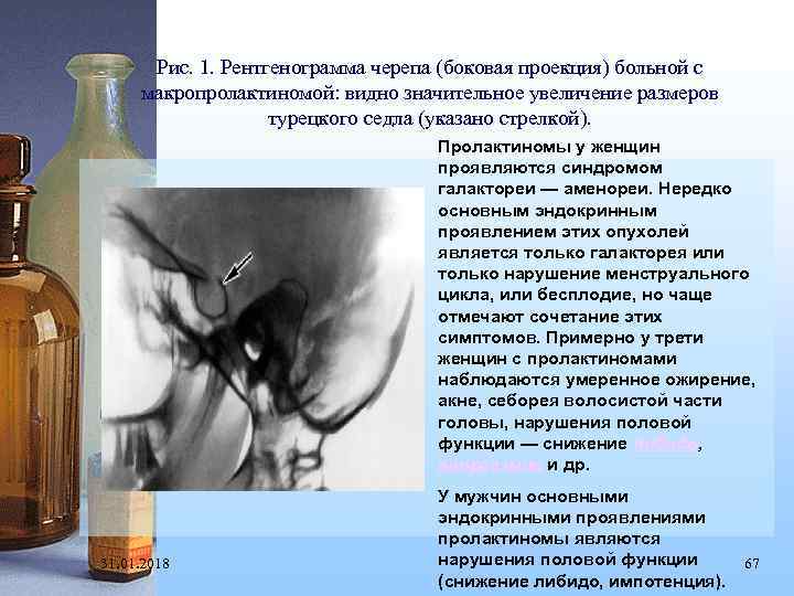 Рис. 1. Рентгенограмма черепа (боковая проекция) больной с макропролактиномой: видно значительное увеличение размеров турецкого