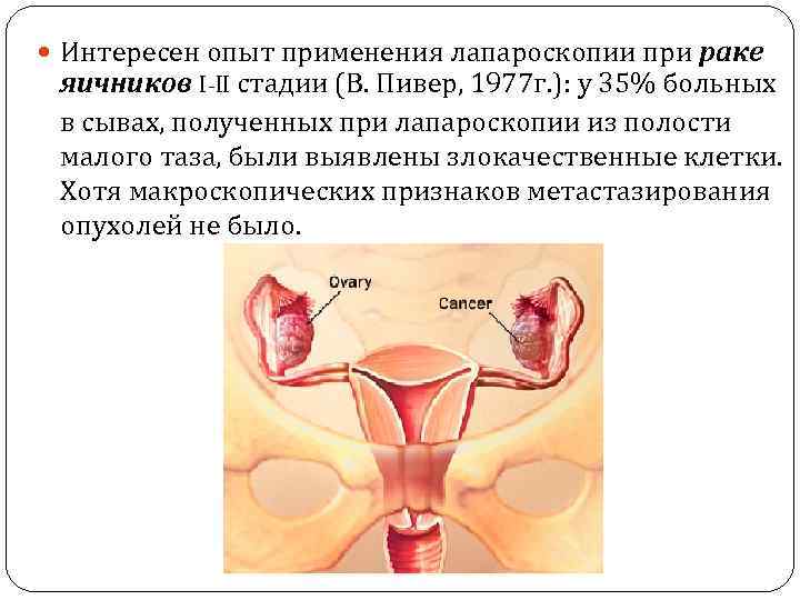  Интересен опыт применения лапароскопии при раке яичников I-II стадии (В. Пивер, 1977 г.