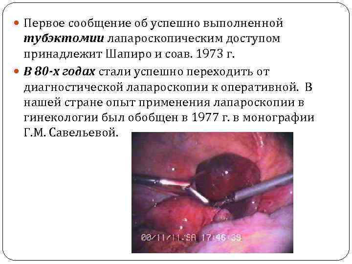  Первое сообщение об успешно выполненной тубэктомии лапароскопическим доступом принадлежит Шапиро и соав. 1973