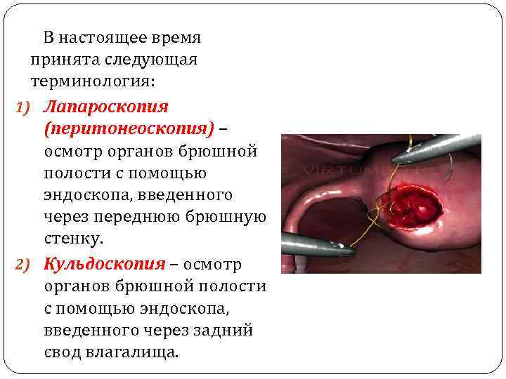  В настоящее время принята следующая терминология: 1) Лапароскопия (перитонеоскопия) – осмотр органов брюшной