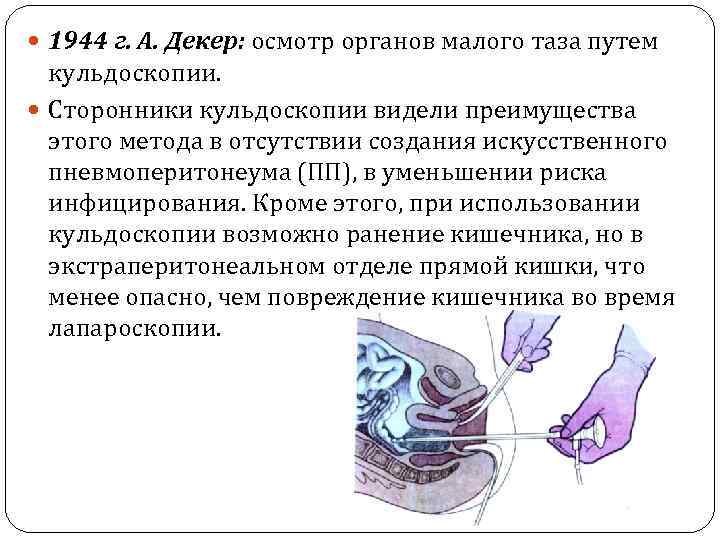 1944 г. А. Декер: осмотр органов малого таза путем кульдоскопии. Сторонники кульдоскопии видели