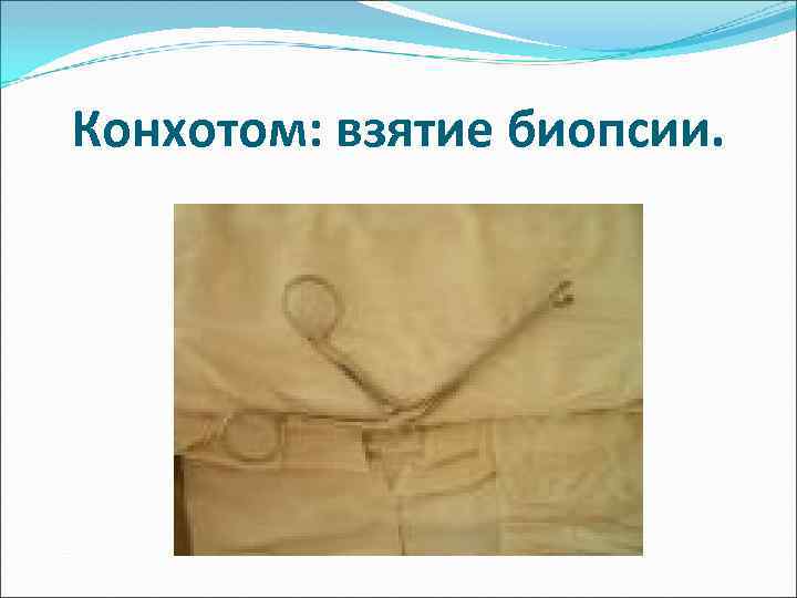 Конхотом: взятие биопсии. 