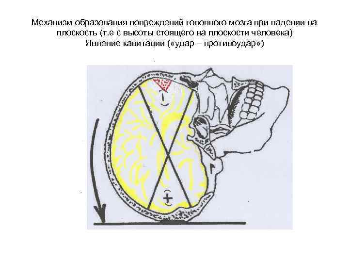 Механизм образования повреждений головного мозга при падении на плоскость (т. е с высоты стоящего