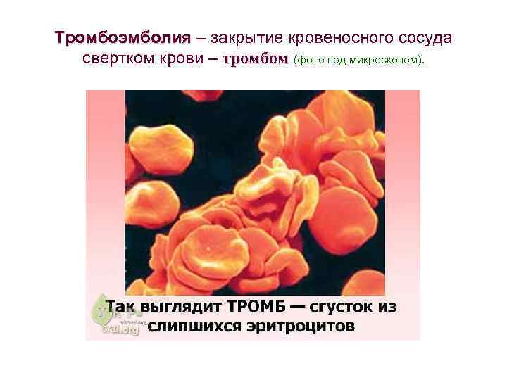 Тромбоэмболия – закрытие кровеносного сосуда Тромбоэмболия свертком крови – тромбом (фото под микроскопом). тромбом
