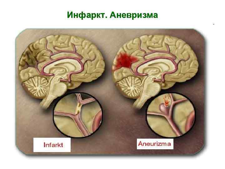 Инфаркт. Аневризма 