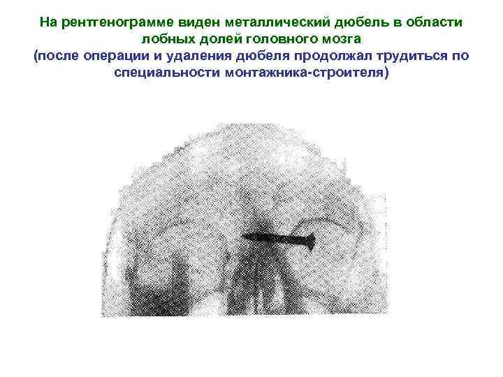 На рентгенограмме виден металлический дюбель в области лобных долей головного мозга (после операции и