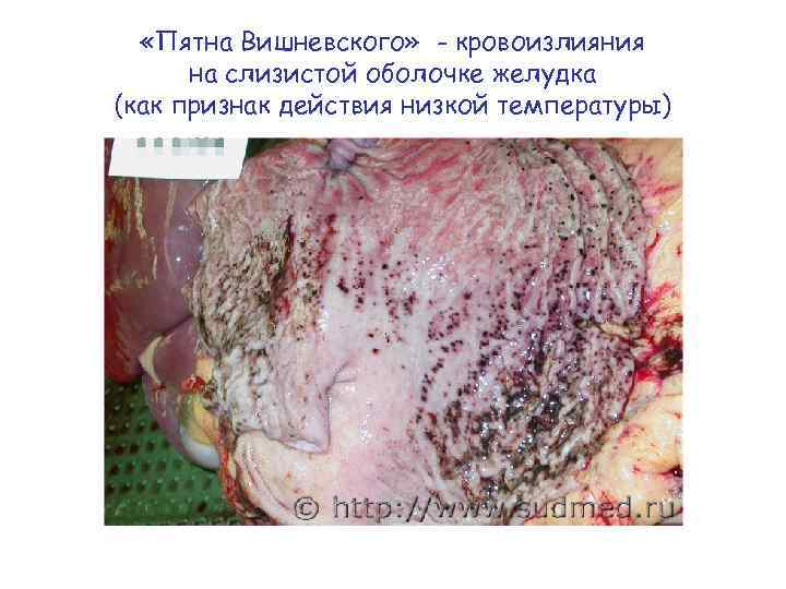  «Пятна Вишневского» - кровоизлияния на слизистой оболочке желудка (как признак действия низкой температуры)