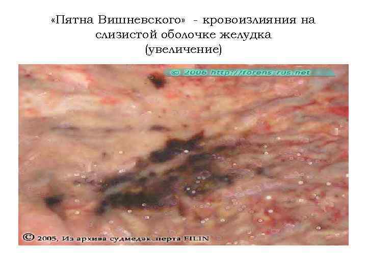  «Пятна Вишневского» - кровоизлияния на слизистой оболочке желудка (увеличение) 