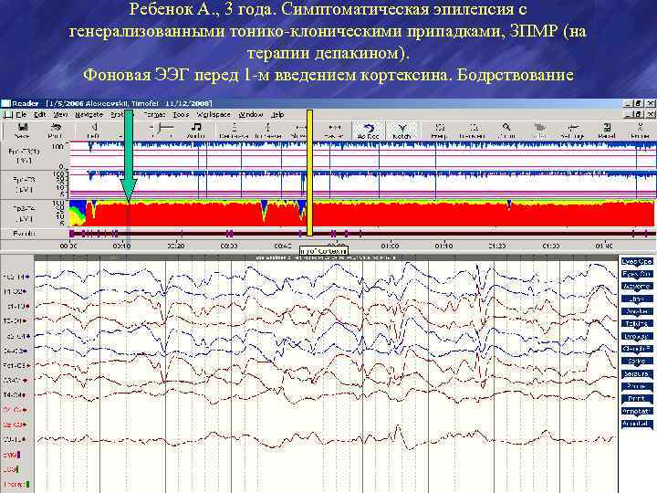 Ребенок А. , 3 года. Симптоматическая эпилепсия с генерализованными тонико-клоническими припадками, ЗПМР (на терапии