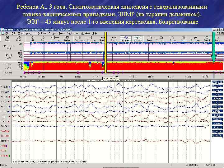 Ребенок А. , 3 года. Симптоматическая эпилепсия с генерализованными тонико-клоническими припадками, ЗПМР (на терапии