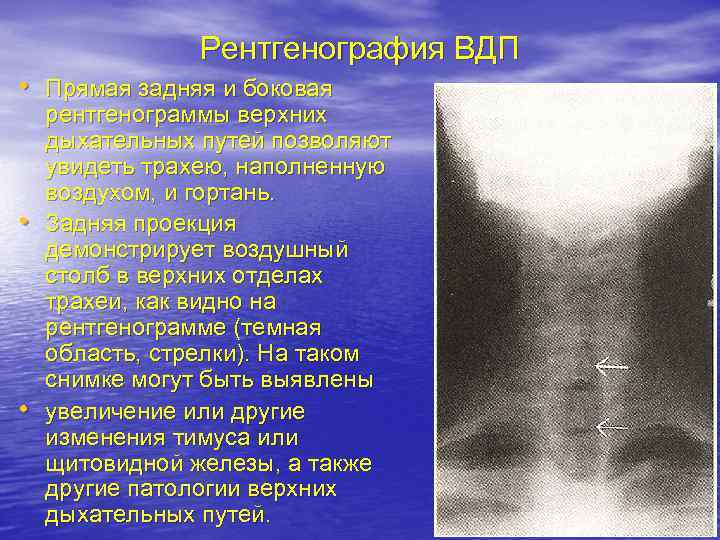 Рентгенография ВДП • Прямая задняя и боковая • • рентгенограммы верхних дыхательных путей позволяют