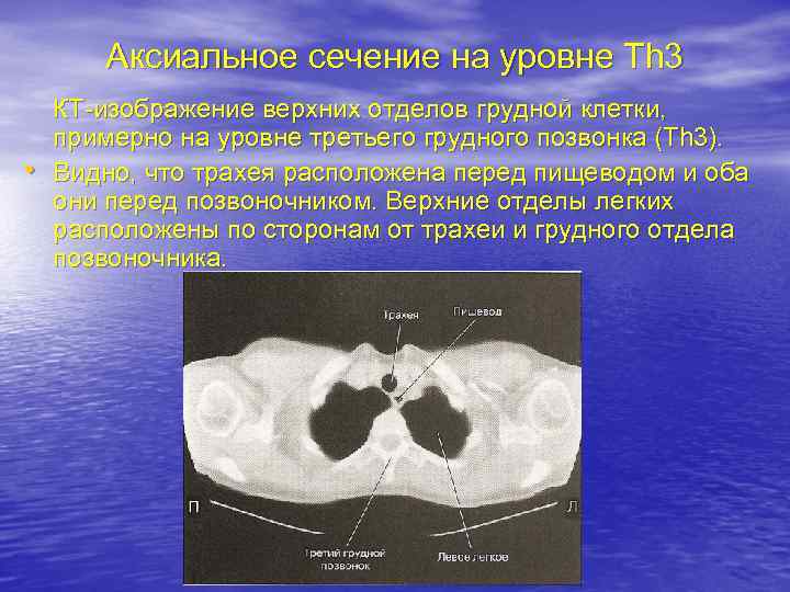 Аксиальное сечение на уровне Th 3 • КТ-изображение верхних отделов грудной клетки, примерно на