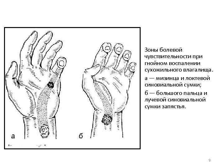 Зоны болевой чувствительности при гнойном воспалении сухожильного влагалища. а — мизинца и локтевой синовиальной
