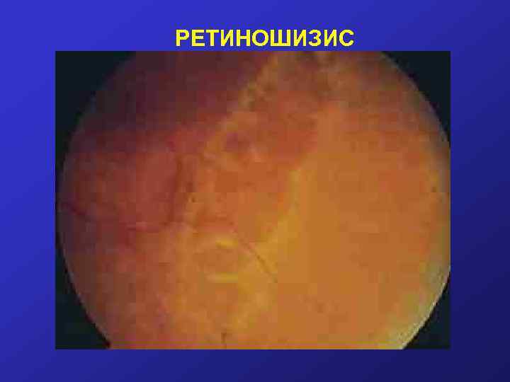 РЕТИНОШИЗИС 