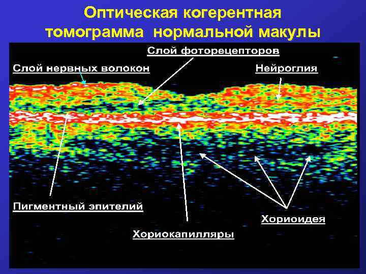 Оптическая когерентная томограмма нормальной макулы 
