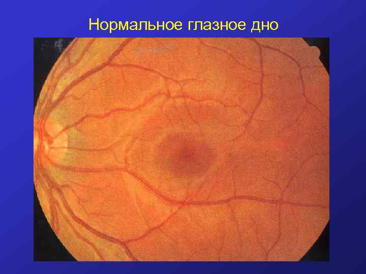 Нормальное глазное дно 