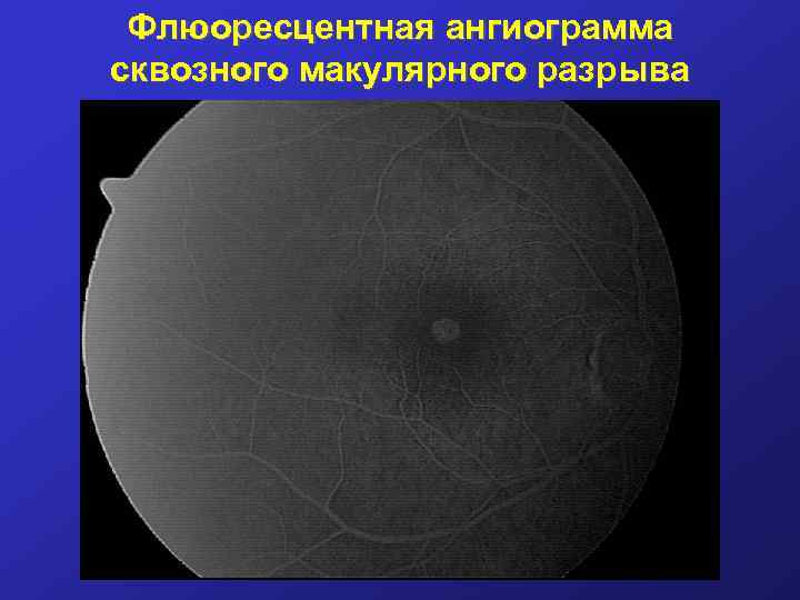 Флюоресцентная ангиограмма сквозного макулярного разрыва 