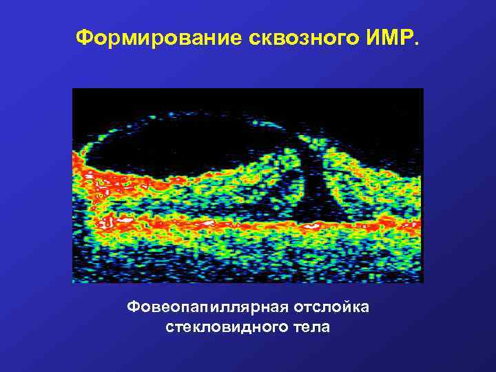 Формирование сквозного ИМР. Фовеопапиллярная отслойка стекловидного тела 