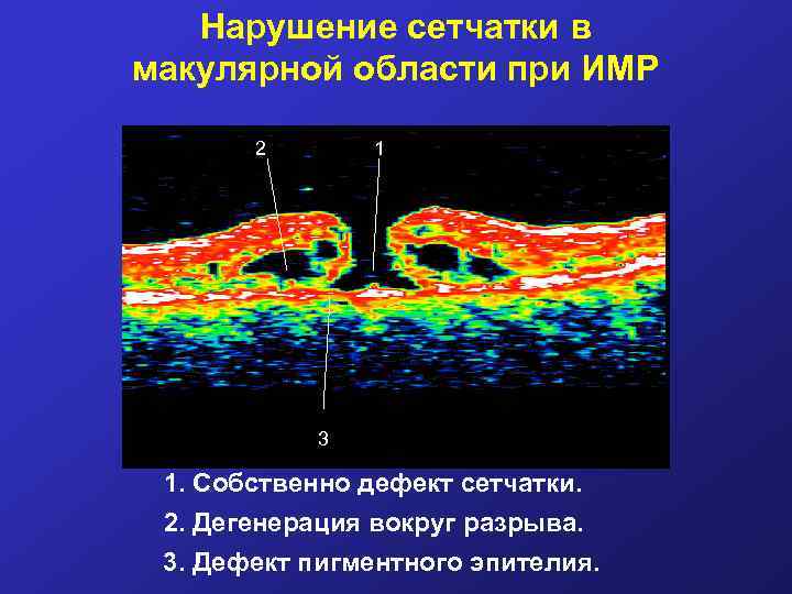 Нарушение сетчатки в макулярной области при ИМР 2 1 3 1. Собственно дефект сетчатки.
