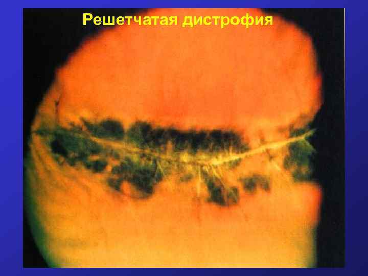 Решетчатая дистрофия 
