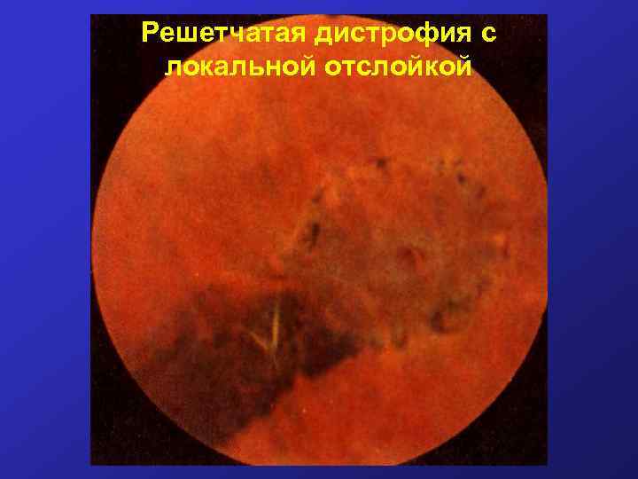 Решетчатая дистрофия с локальной отслойкой 