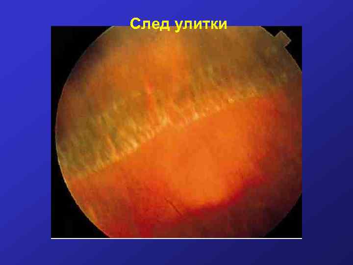 След улитки 