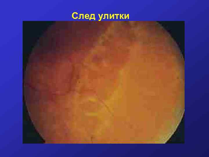 След улитки 