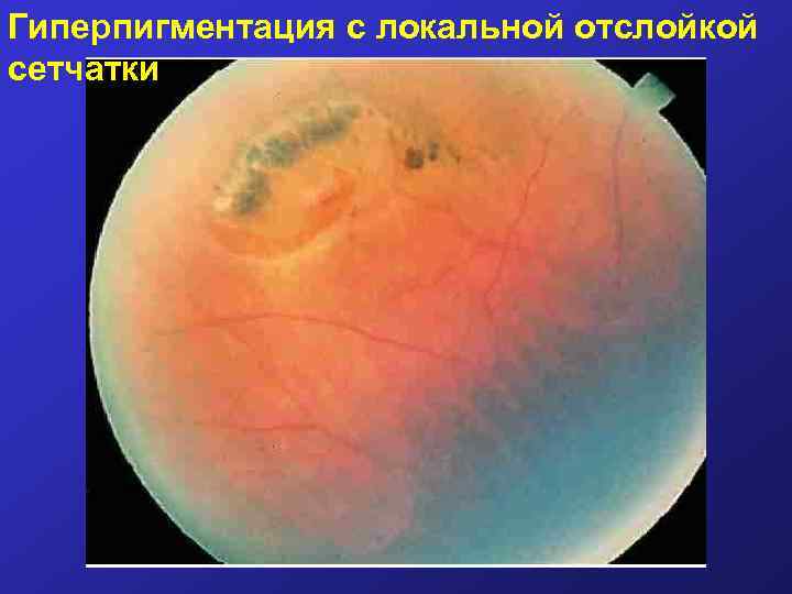 Гиперпигментация с локальной отслойкой сетчатки 