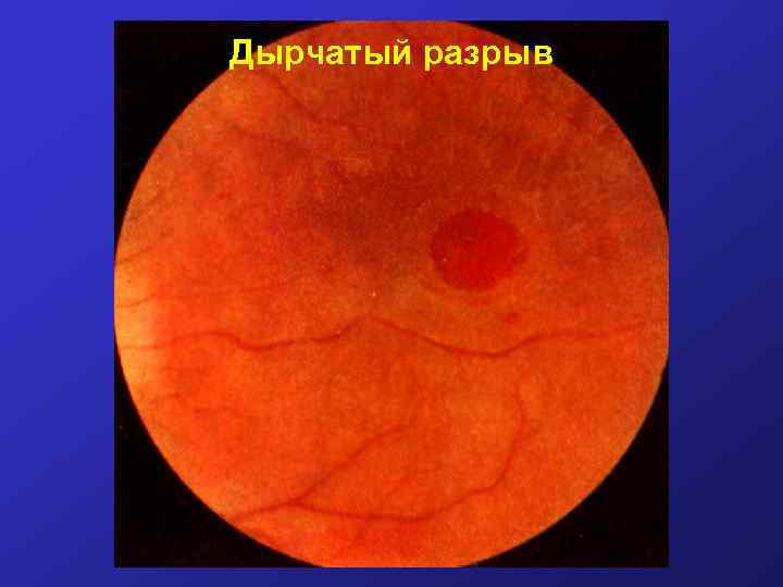 Дырчатый разрыв 