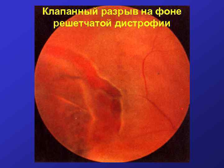 Клапанный разрыв на фоне решетчатой дистрофии 