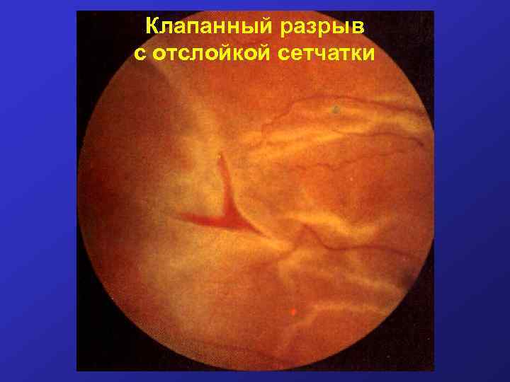 Клапанный разрыв с отслойкой сетчатки 