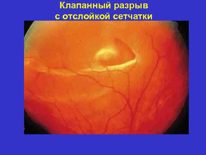 Клапанный разрыв с отслойкой сетчатки 
