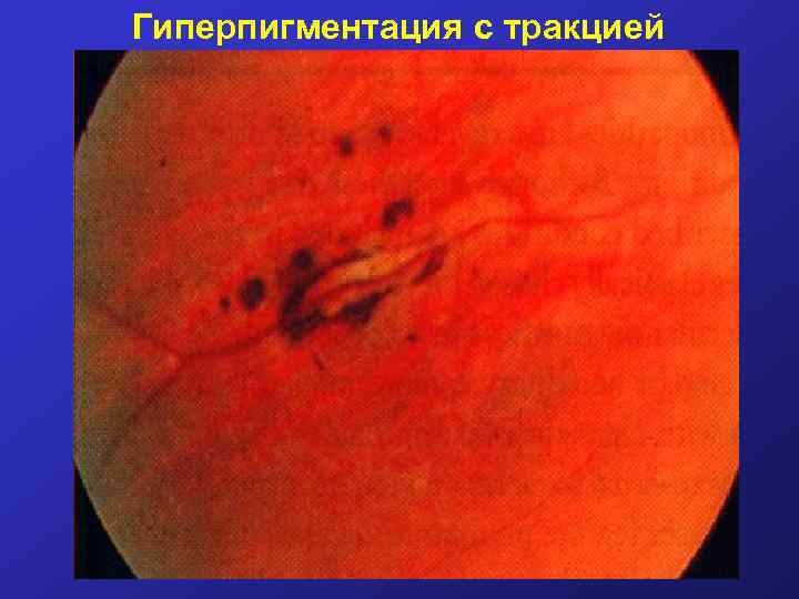 Гиперпигментация с тракцией 