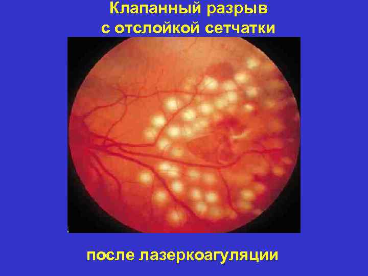 Клапанный разрыв с отслойкой сетчатки после лазеркоагуляции 