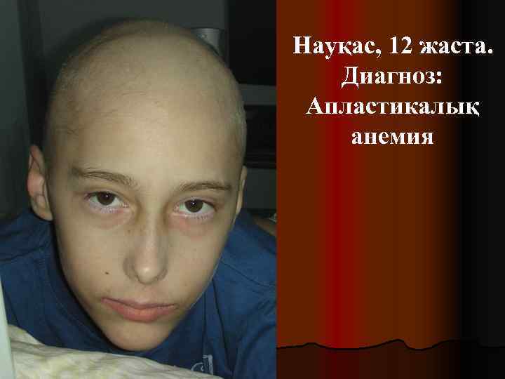 Науқас, 12 жаста. Диагноз: Апластикалық анемия 