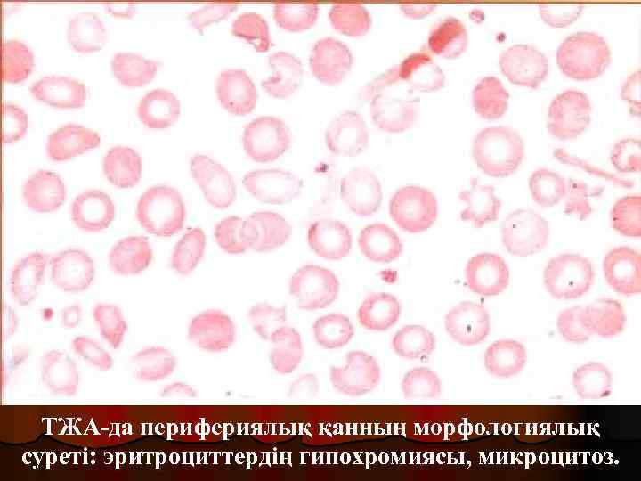 ТЖА-да перифериялық қанның морфологиялық суреті: эритроциттердің гипохромиясы, микроцитоз. 
