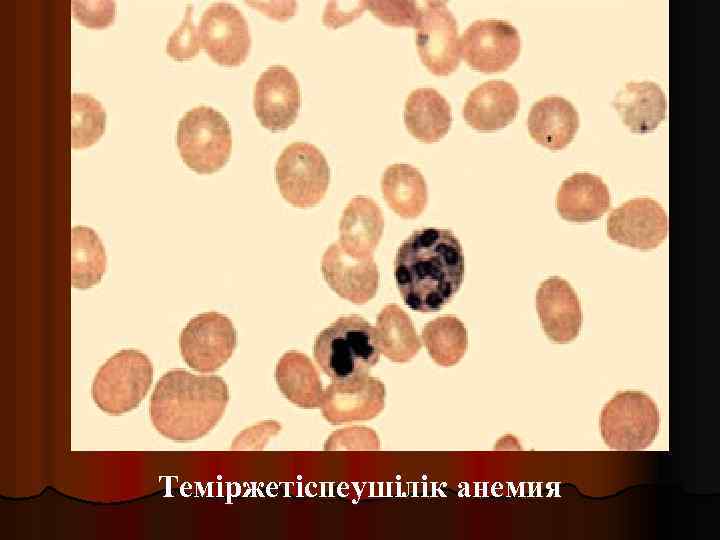 Теміржетіспеушілік анемия 