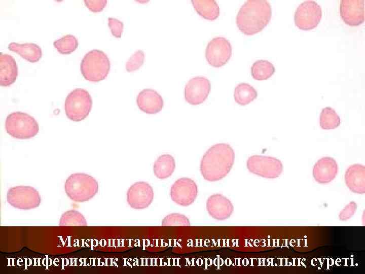 Макроцитарлық анемия кезіндегі перифериялық қанның морфологиялық суреті. 
