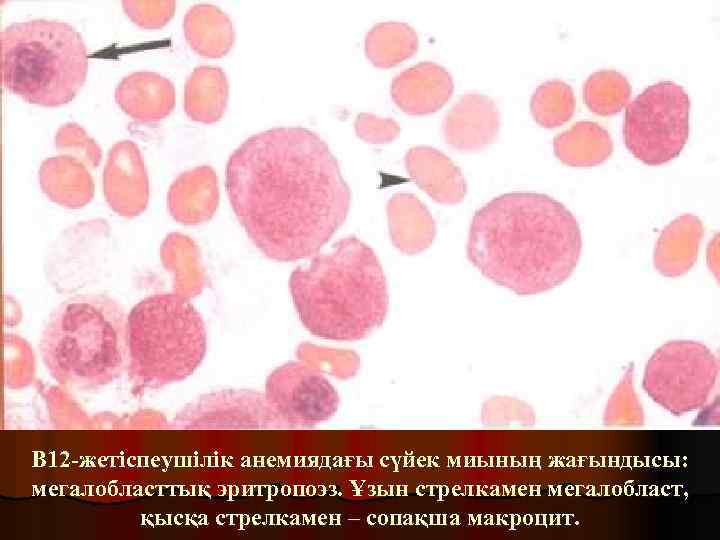 В 12 -жетіспеушілік анемиядағы сүйек миының жағындысы: мегалобласттық эритропоэз. Ұзын стрелкамен мегалобласт, қысқа стрелкамен
