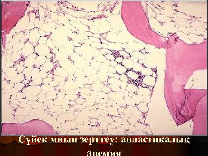 Сүйек миын зерттеу: апластикалық 