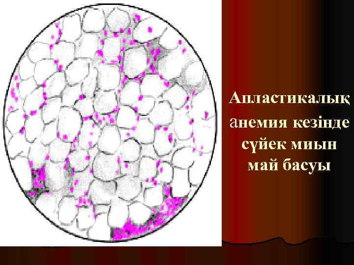 Апластикалық анемия кезінде сүйек миын май басуы 