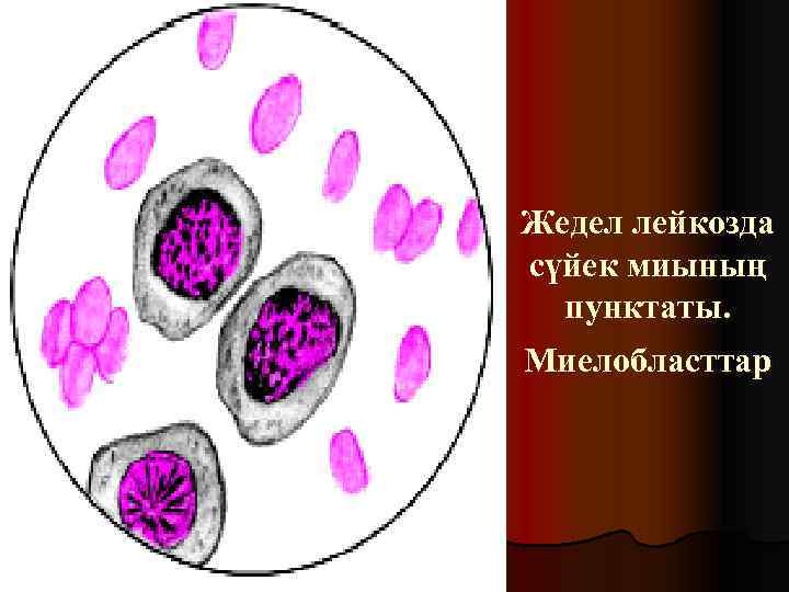 Жедел лейкозда сүйек миының пунктаты. Миелобласттар 
