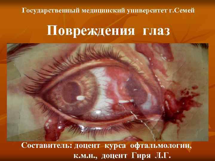 Государственный медицинский университет г. Семей Повреждения глаз Составитель: доцент курса офтальмологии, к. м. н.