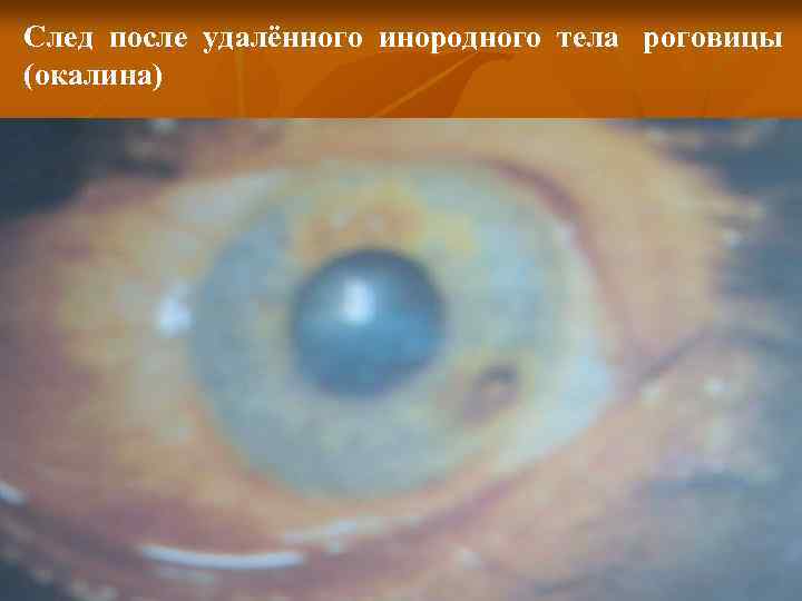 След после удалённого инородного тела роговицы (окалина) 
